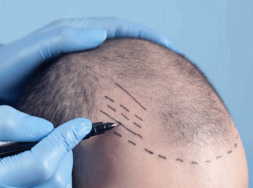 Hair-Transplant-Surgery-Before-and-After