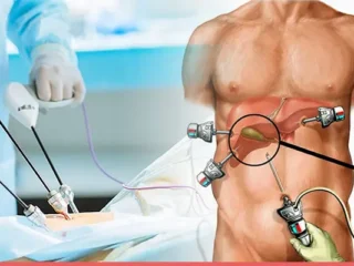 Laparoscopic-Gallbladder-Surgery-Stones-Removal-Treatment (1)